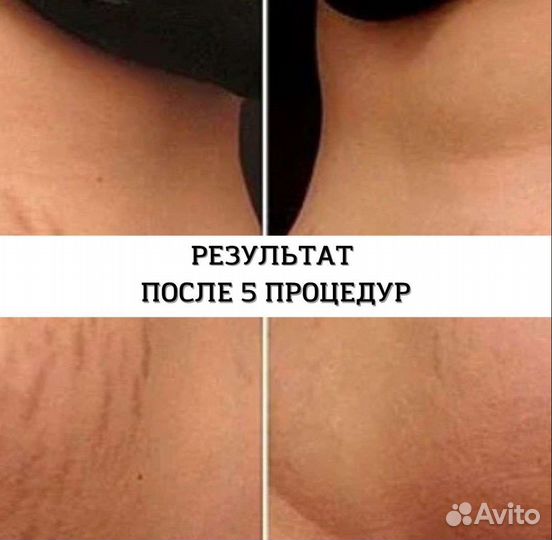 Удаление рубцов и растяжек(стрии)