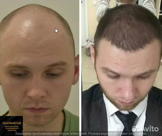 Пересадка волос, бороды Россия/ Турция