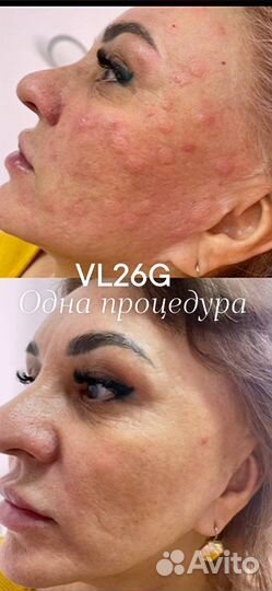 Сыворотка vl26g