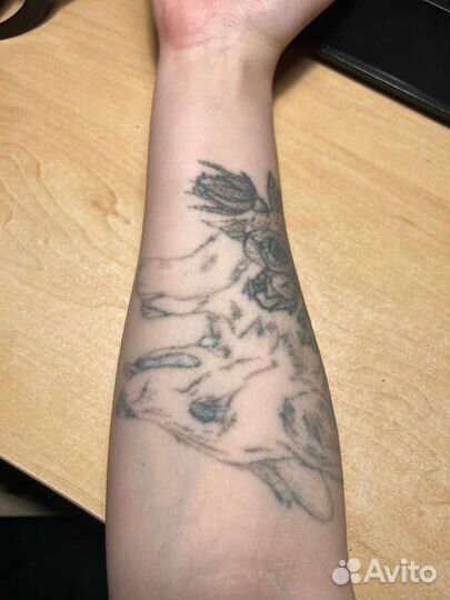 Лазерное удаление тату татуажа перманента