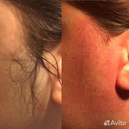 Депиляция -Косметология