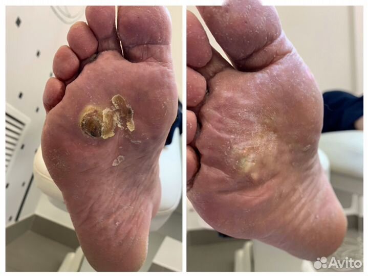 Лечебный педикюр подолог