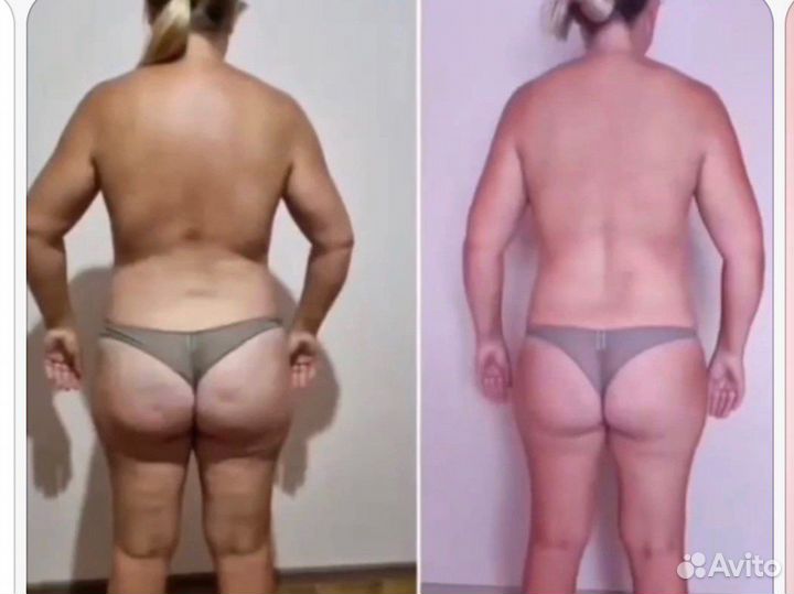 Гидромассаж (подводный вакуумный массаж)