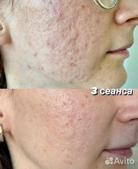 Микроигольчатый RF лифтинг