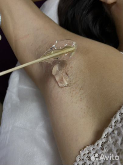 Лазерная эпиляция: глубокое бикини