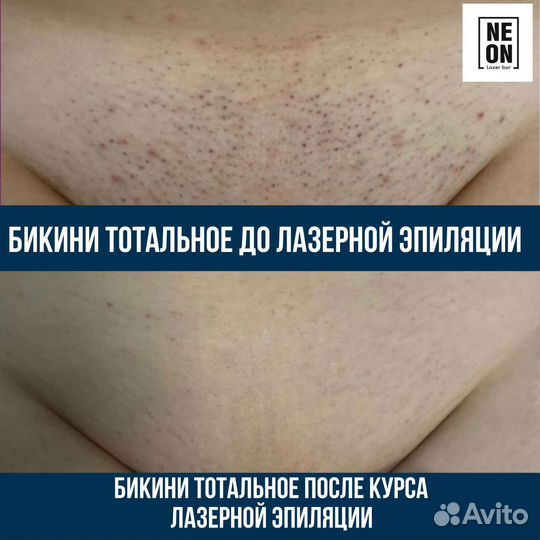 Лазерная эпиляция на диодном лазере