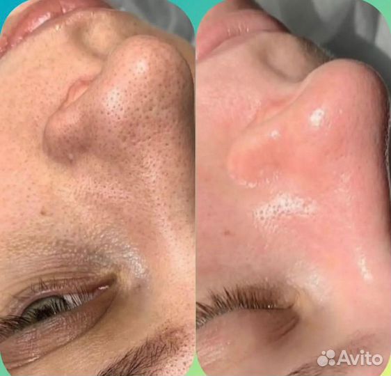 Чистка лица