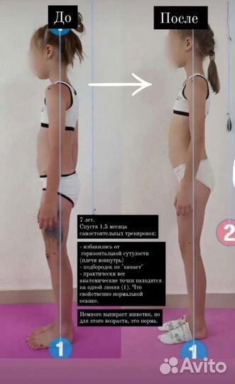 Коррекция осанки, лечение сколиоза, плоскостопие