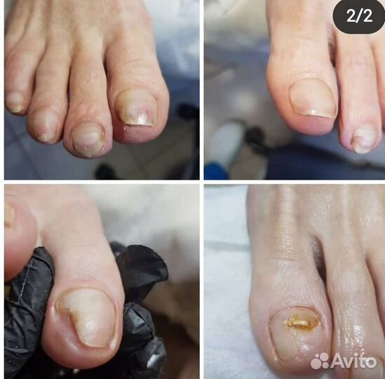 Медицинский педикюр