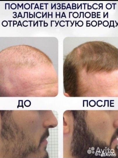 Миноксидил для роста волос и бороды