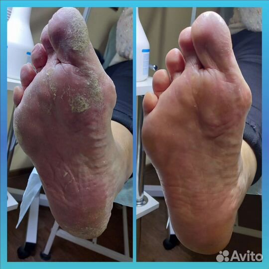 Педикюр любой сложности