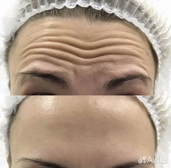 Ботокс для лица