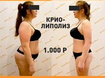 Криолиполиз. Плоский живот + стройные бедра