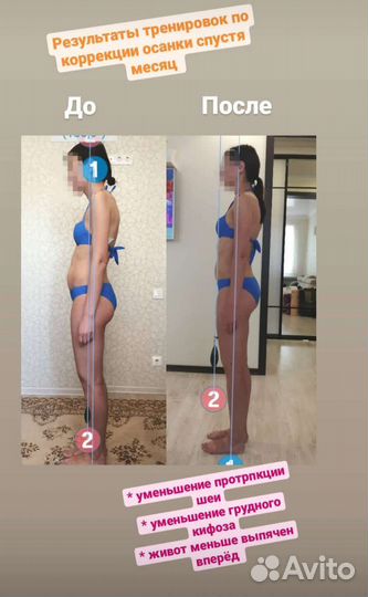 Коррекция осанки, лечение сколиоза, плоскостопие