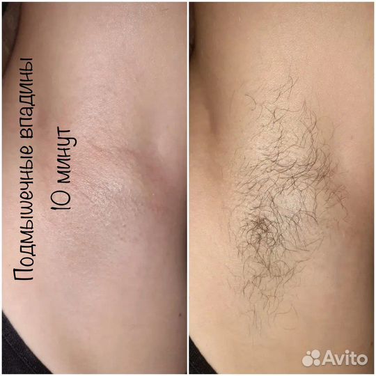 Депиляция воском: глубокое бикини