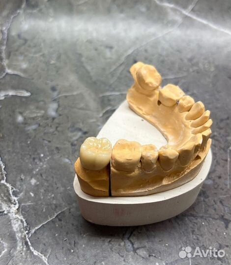 Зубные протезы