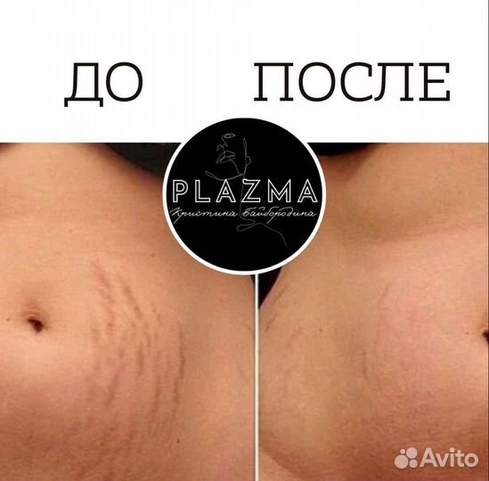 Удаление рубцов и растяжек(стрии)