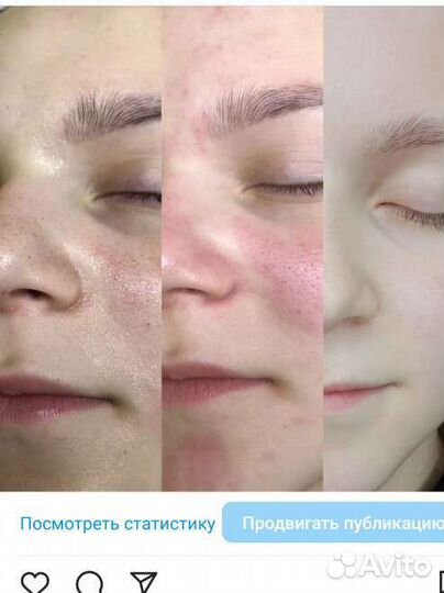 Шугаринг на дому сахарной пастой