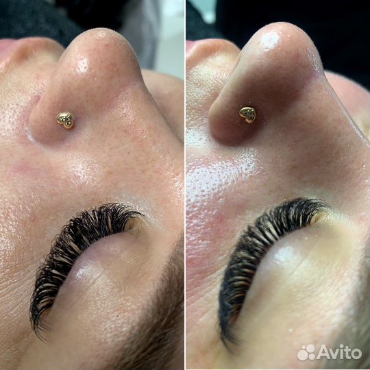 Карбокситерапия