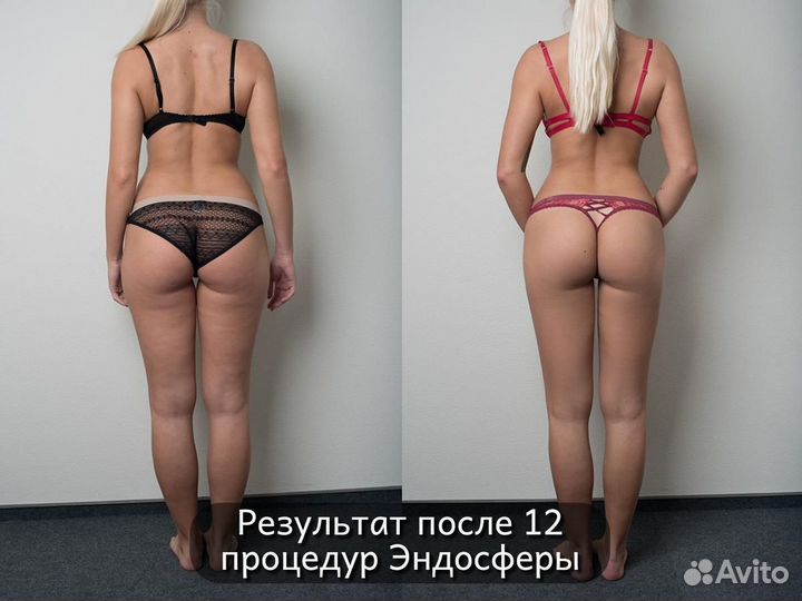 Модели на антицеллюлитный массаж (эндосфера)