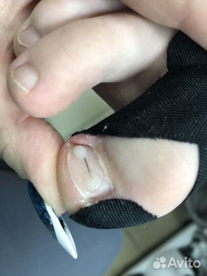 Педикюр лечебный, подология.наращивание ногтей