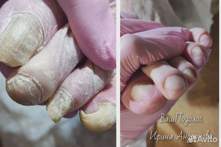 Подолог.Педикюр,вросший ноготь,трещины,мозоли