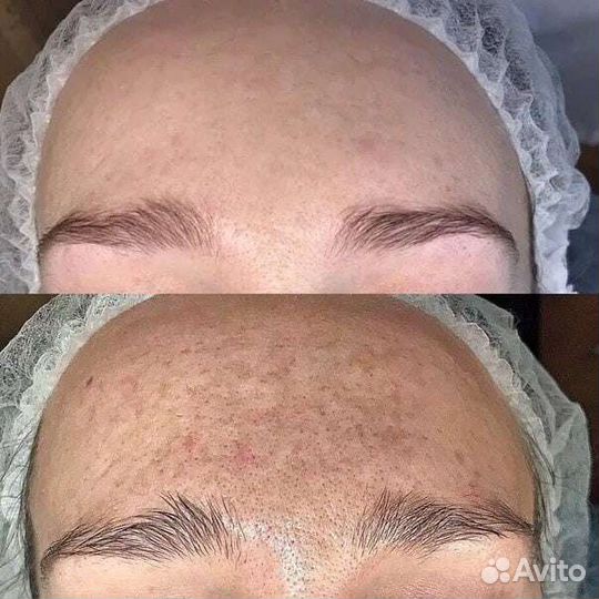 Чистка лица