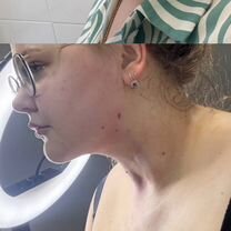 Липоредукция подбородка, живота. Убрать жир, Лобня