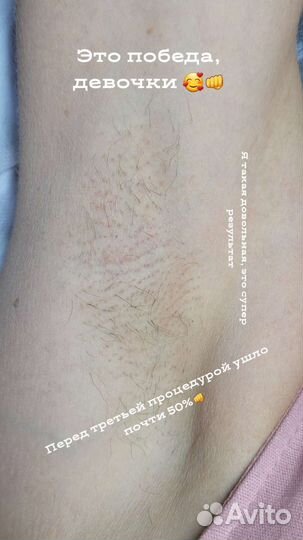 Электроэпиляция