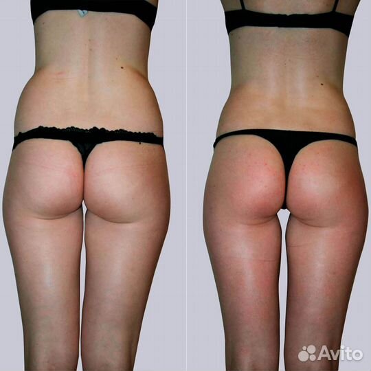 Эндосфера, похудение за 1 сеанс