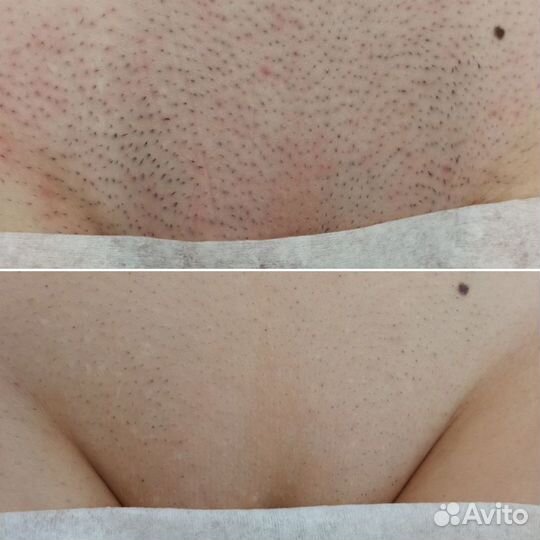 Лазерная эпиляция в Воронеже