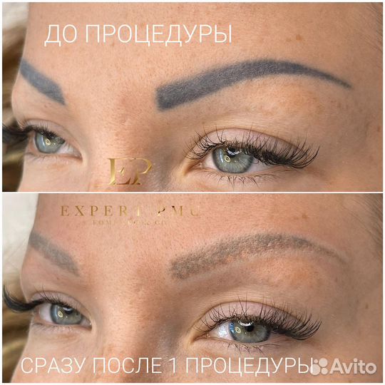 Неодимовый Лазер Аппарат ND Yag MonaLiza