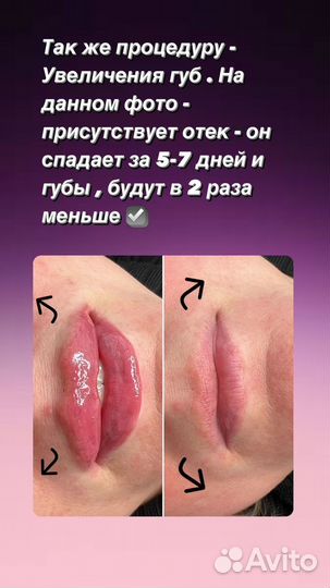 Модель на Увеличение губ