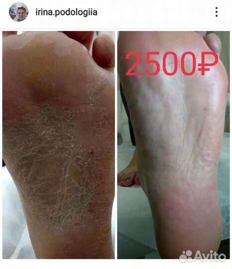 Педикюр гигиенический (медицинский). Выезд на дом