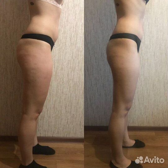 Массаж Антицеллюлитный