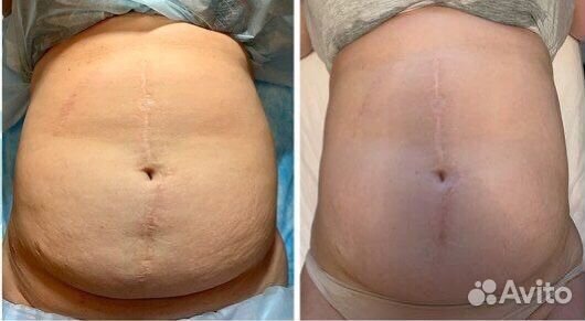 Кавитация/липолиз/прессотерапия/бочка