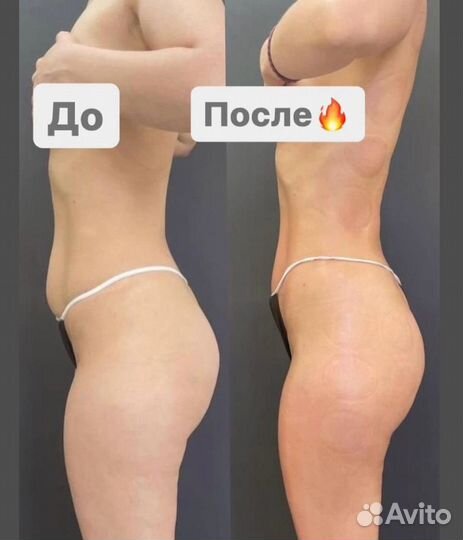 Аппаратный массаж / антицеллюлитный массаж