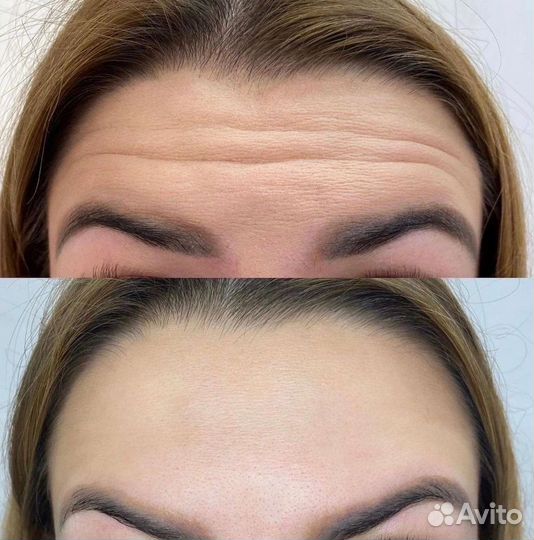 Диспорт, ботулакс