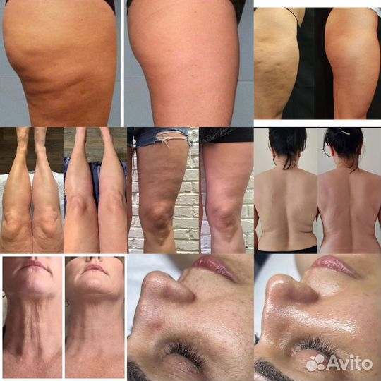 Антицеллюлитный массаж вакуум, кавитация, LPG,RF