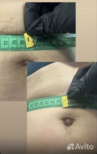 Индиба(Indiba) похудение и омоложения