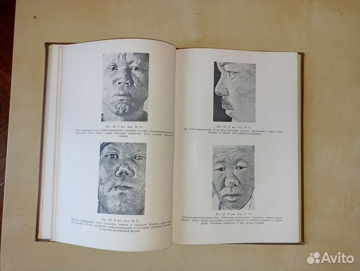 Верхние дыхательные пути и орган слуха при проказе