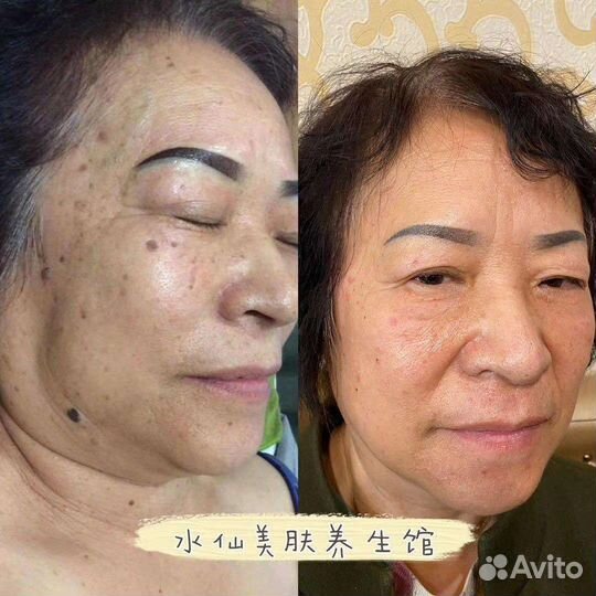 Фотоомолож-е,удаление пигментации,веснушек,купероз