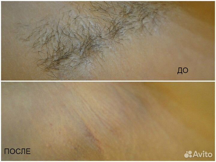 Spa-шугаринг