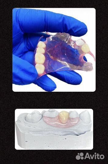Зубные протезы