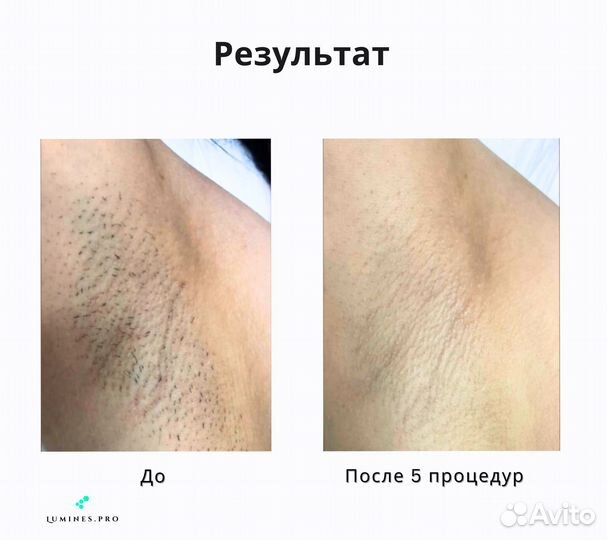 Аппарат для эпиляции Лю’минес Эво’Про 2400W