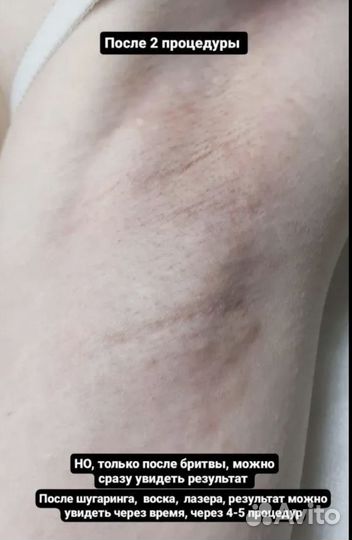 Электроэпиляция модель