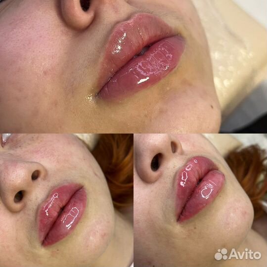 Биоревитализация