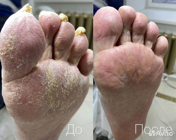 Стрежневая мозоль, Медицинский педикюр, Подолог