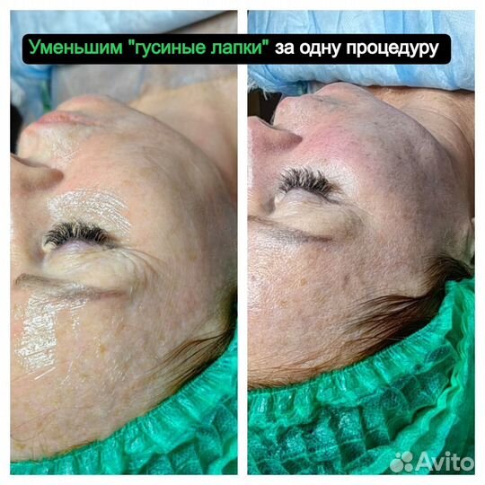 Подтяжка лица. Омоложение. Аппаратная косметология