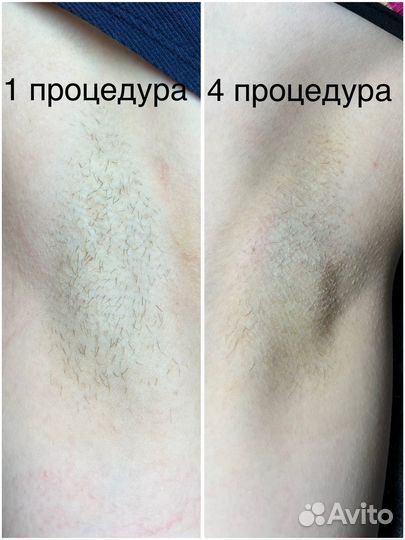 Электроэпиляция